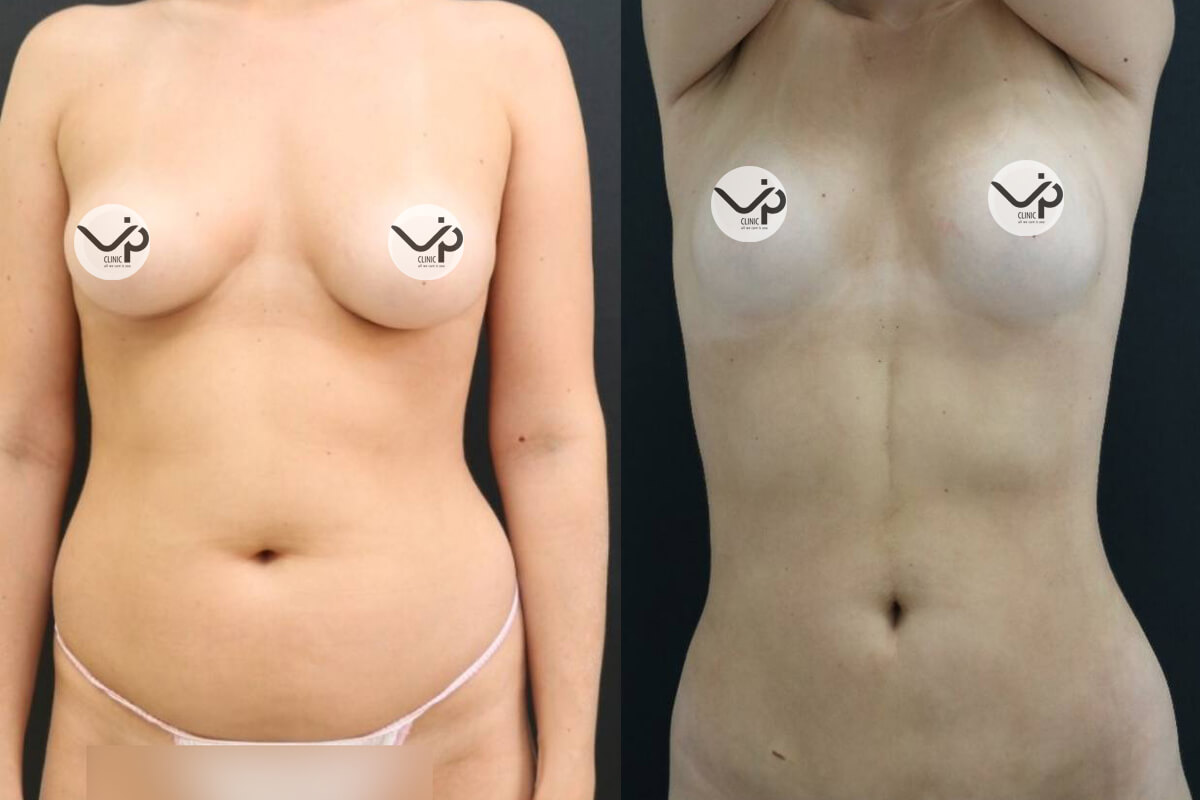 Липомоделирование тела 01