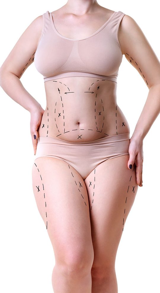 Липомоделирование тела