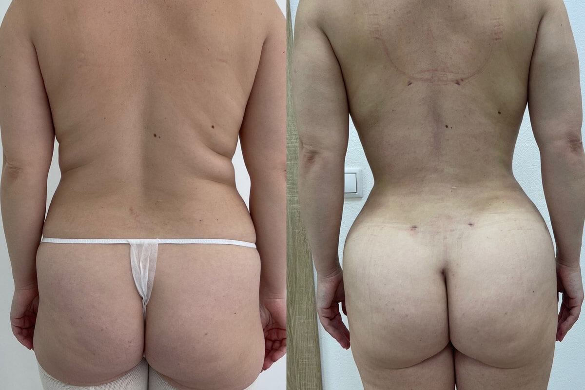 Липомоделирование тела 01