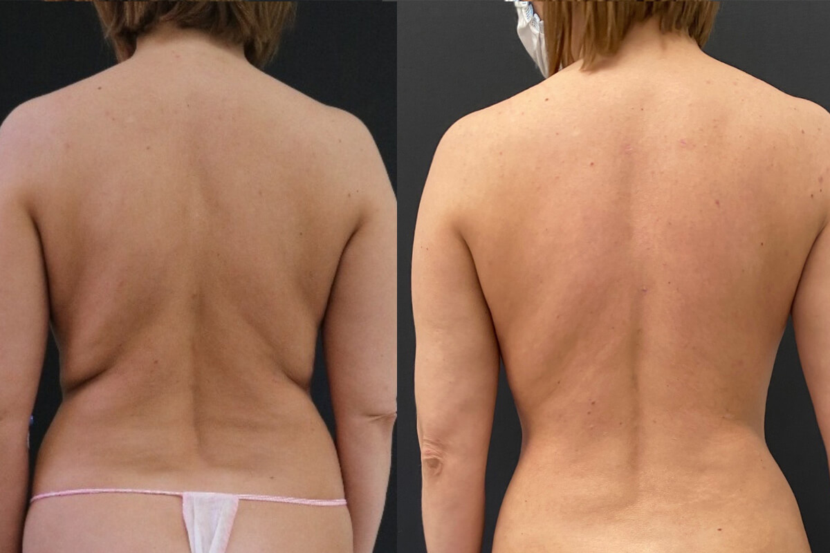 Липосакция спины 01
