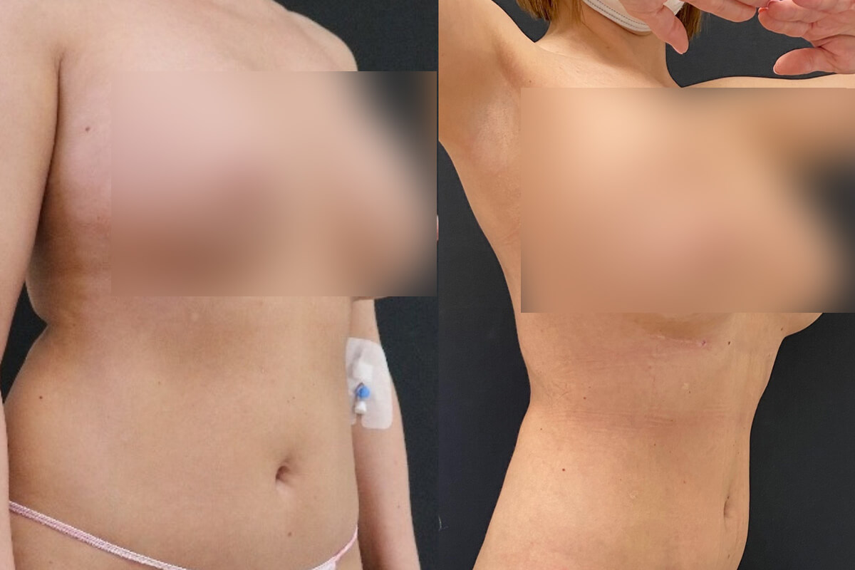 Липосакция живота и боков 01