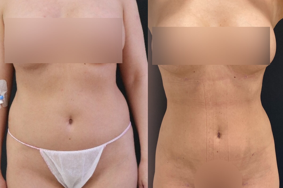 Липосакция живота и боков 01