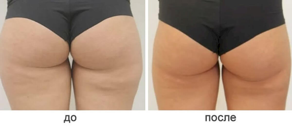 Липосакция ног и ягодиц 01