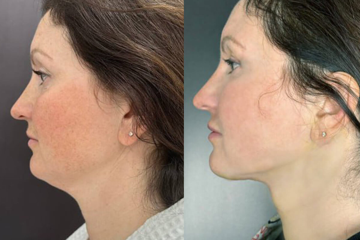 Липосакция подбородка и шеи 01