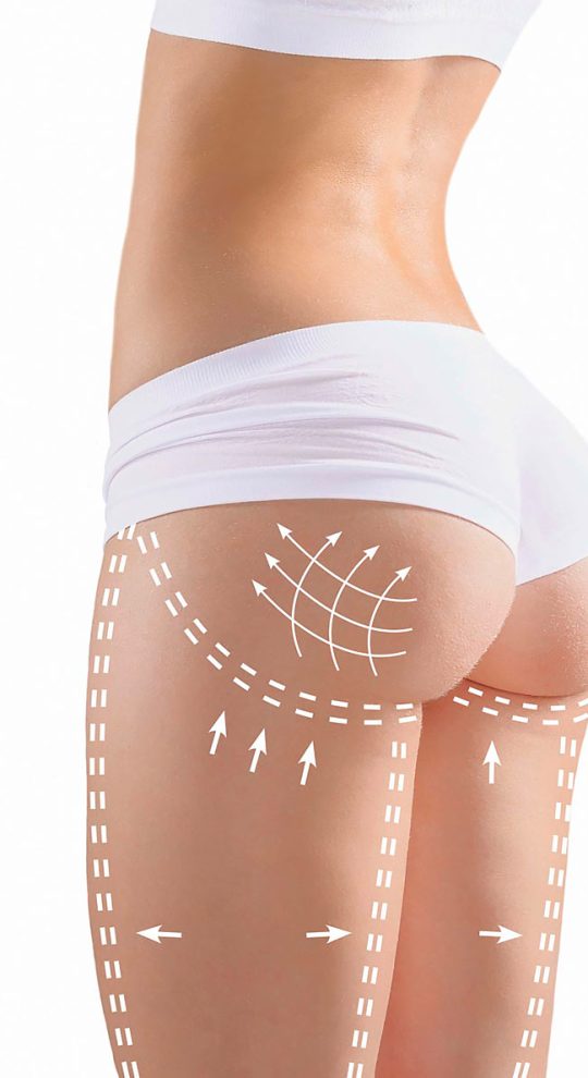 Липосакция ног и ягодиц