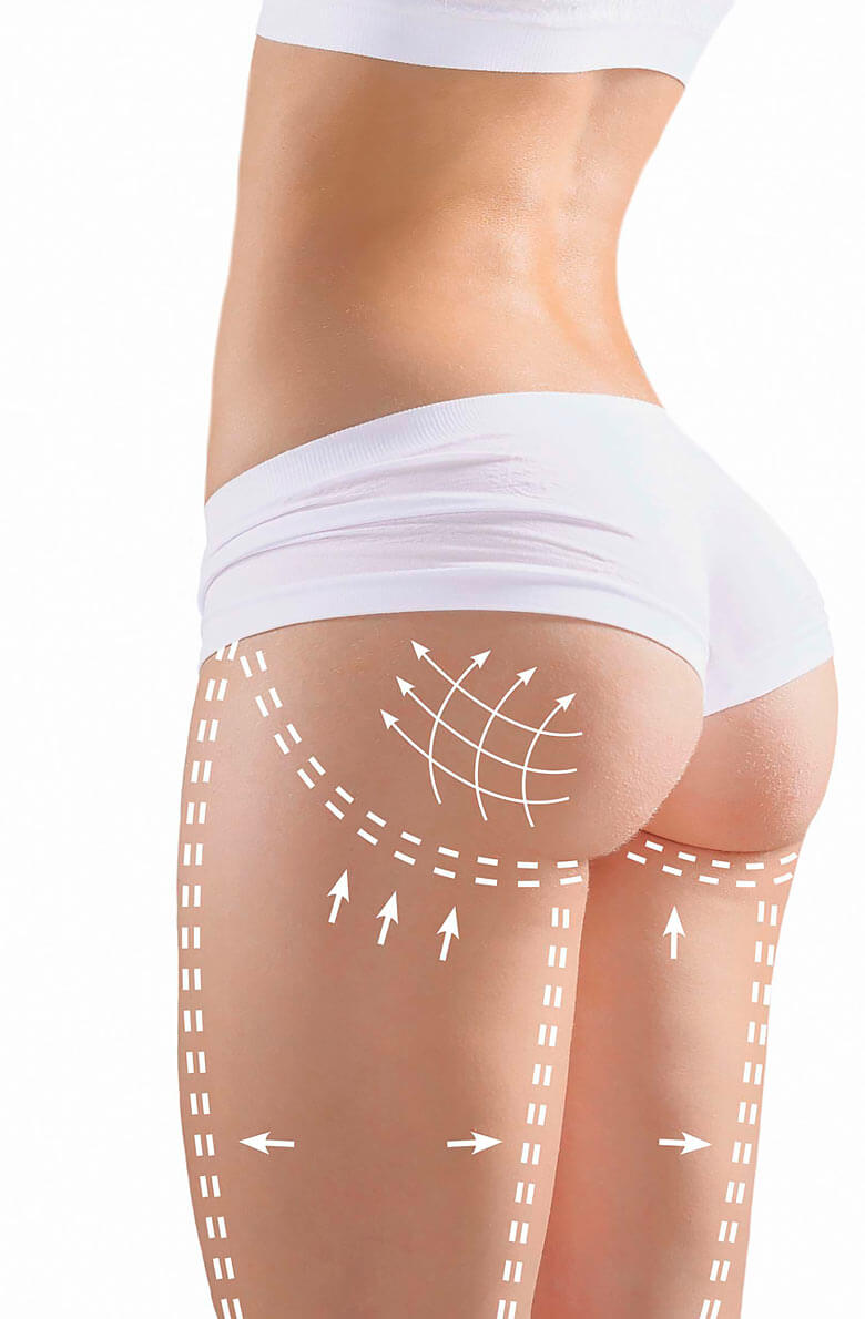 Липосакция ног и ягодиц