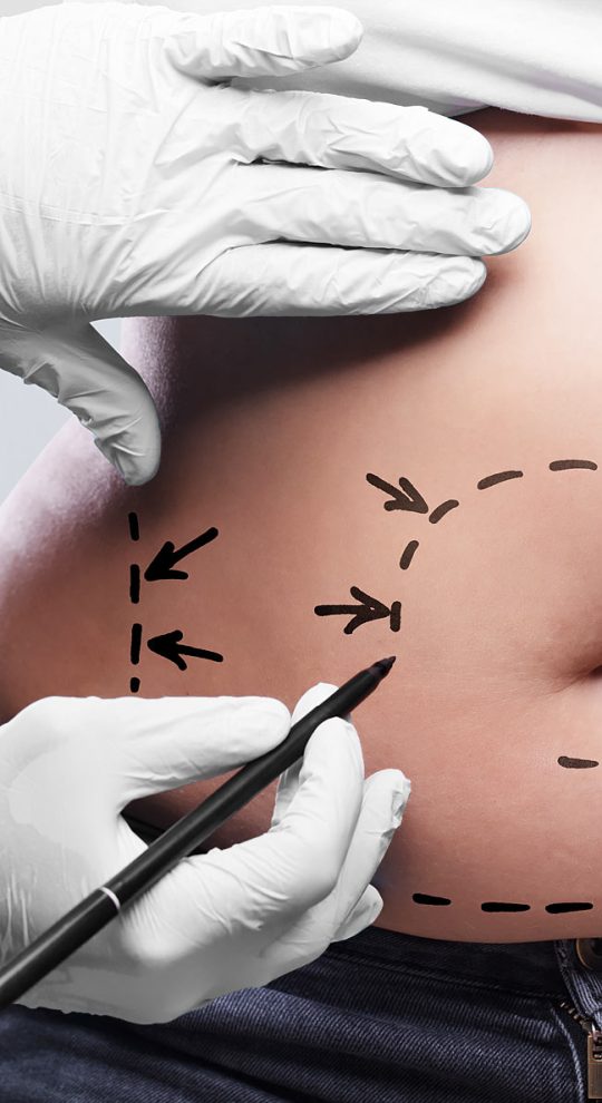 Липосакция живота и боков