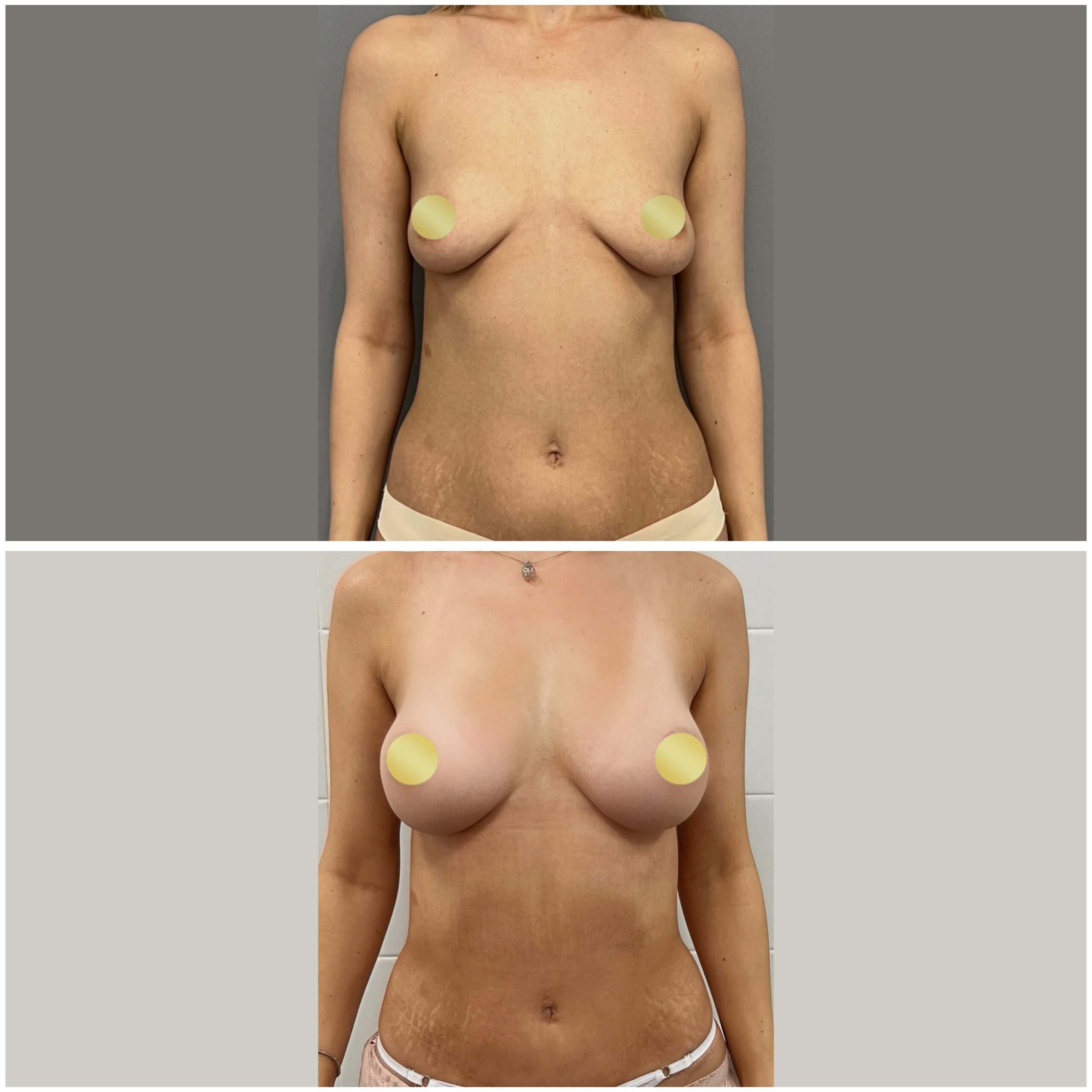 Подтяжка груди (мастопексия) 01