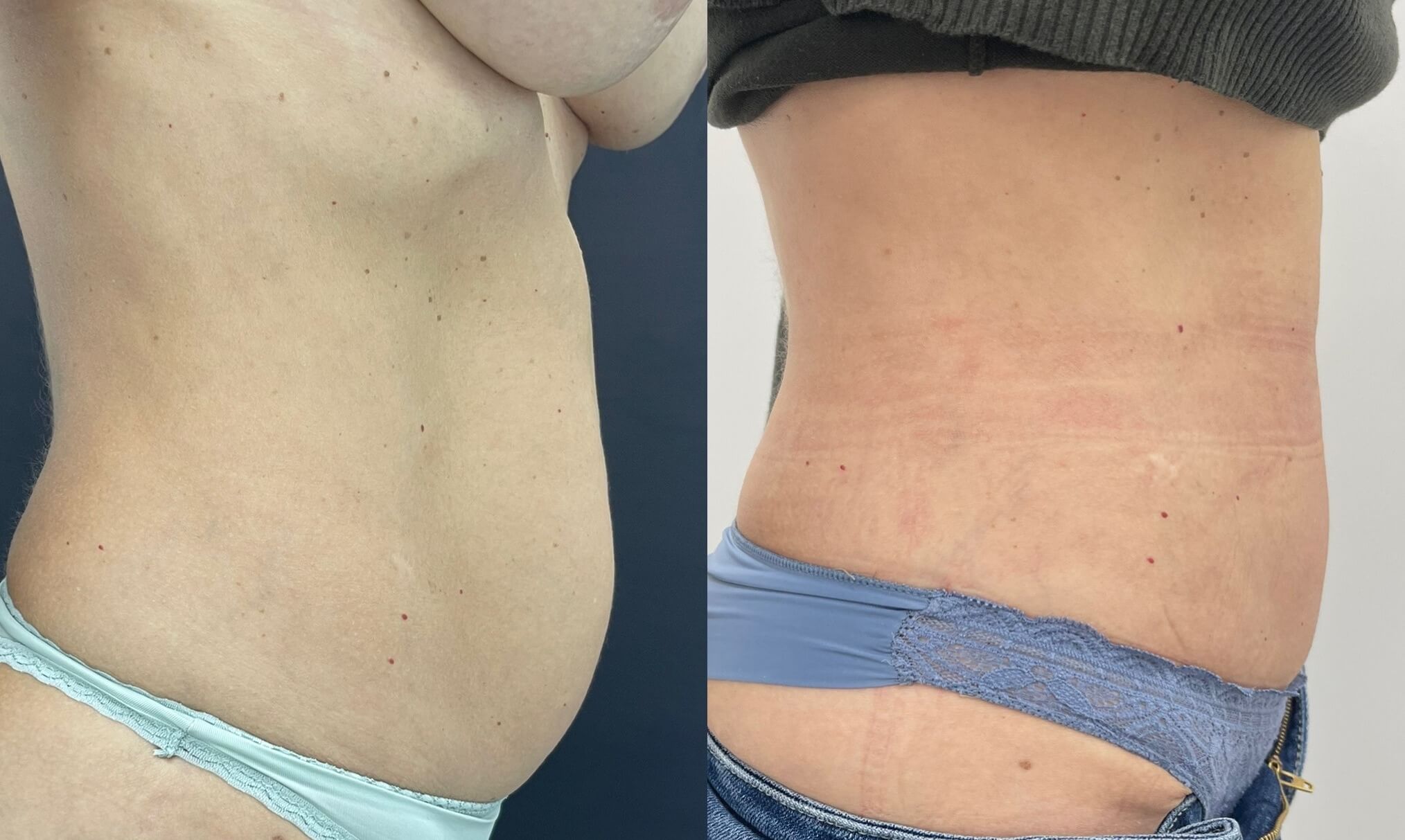 Миниабдоминопластика 01