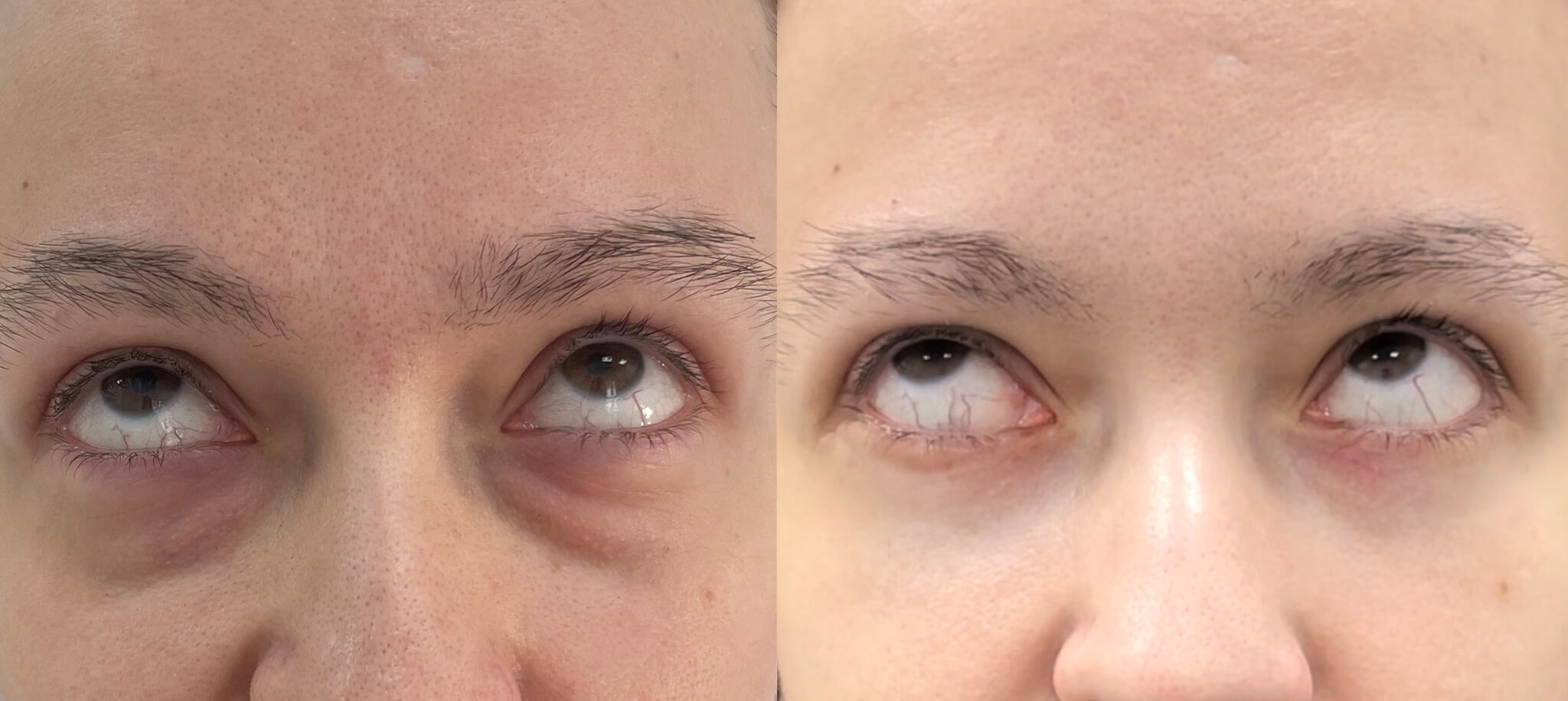 Нижняя блефаропластика 01