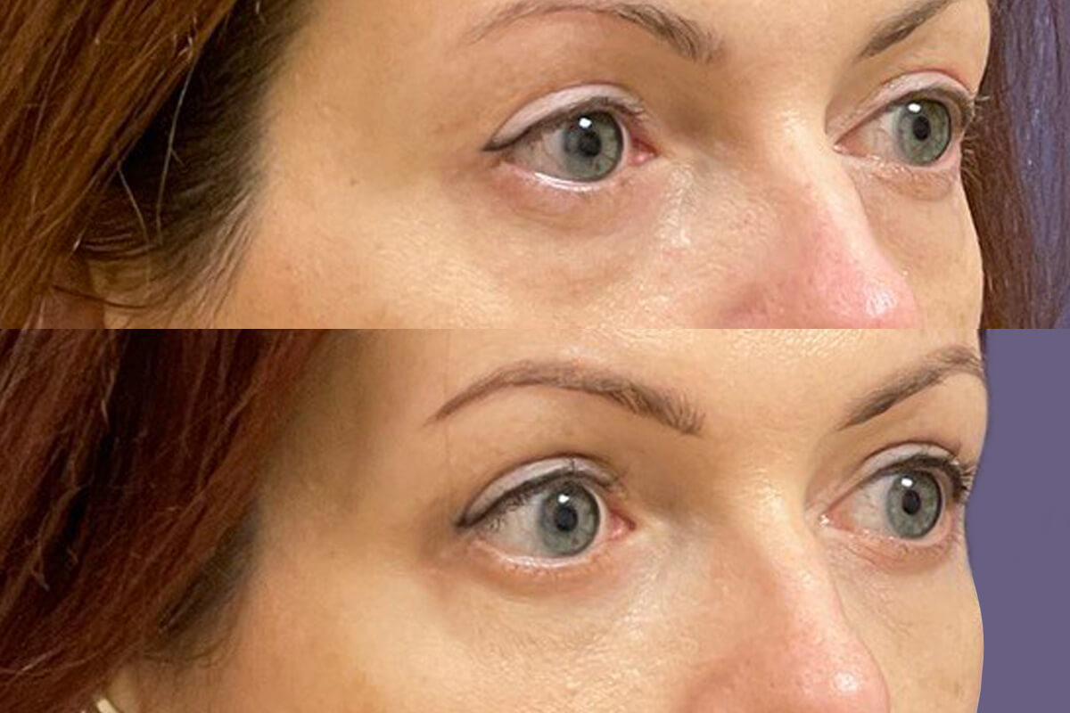 Нижняя блефаропластика 01