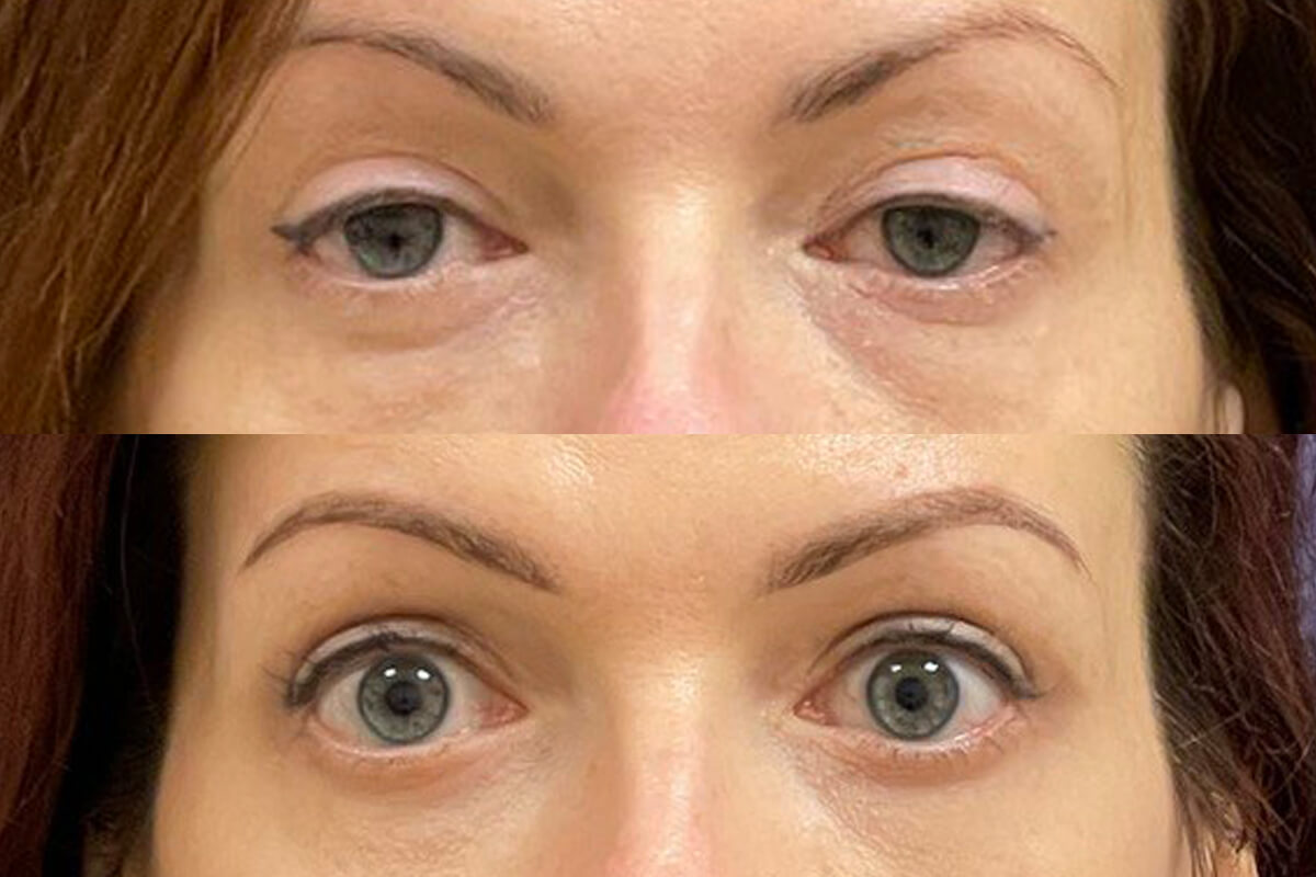 Нижняя блефаропластика 01