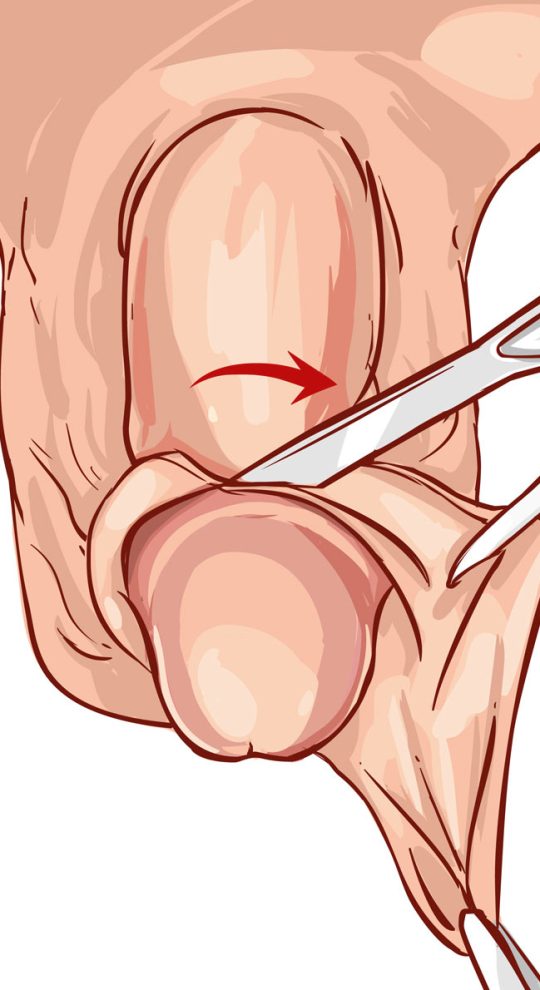 Интимная пластика у мужчин