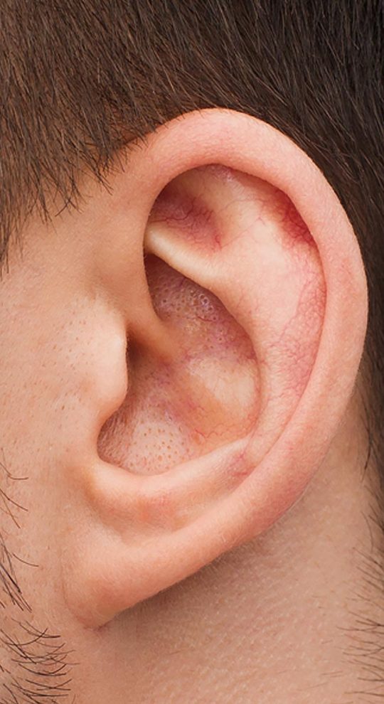 Отопластика