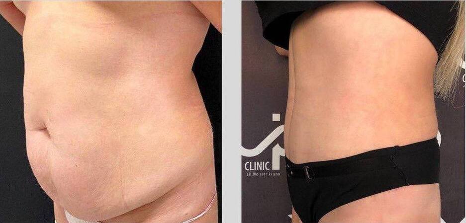 Миниабдоминопластика 01