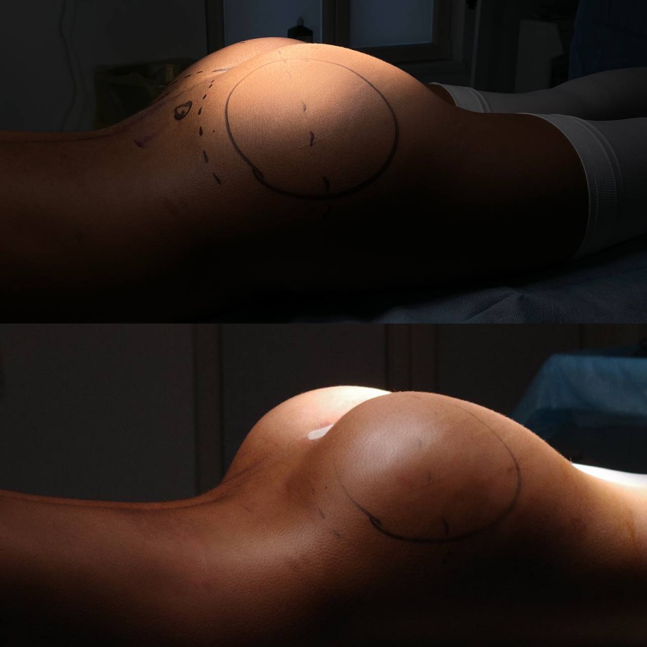 Увеличение ягодиц имплантами 01