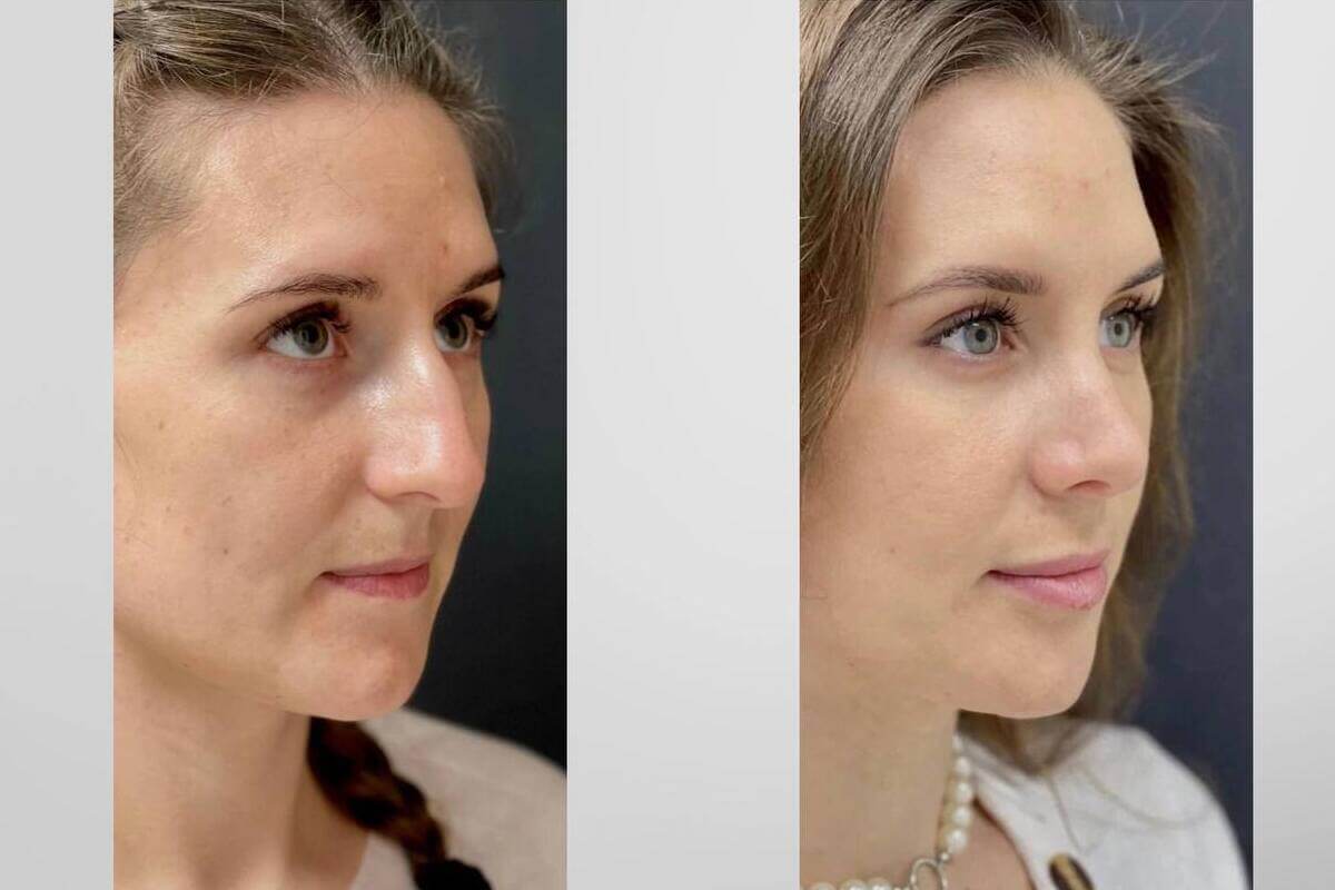 Ринопластика 01