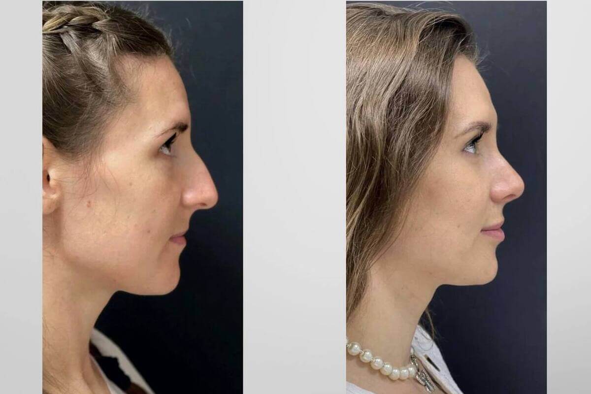 Ринопластика 01