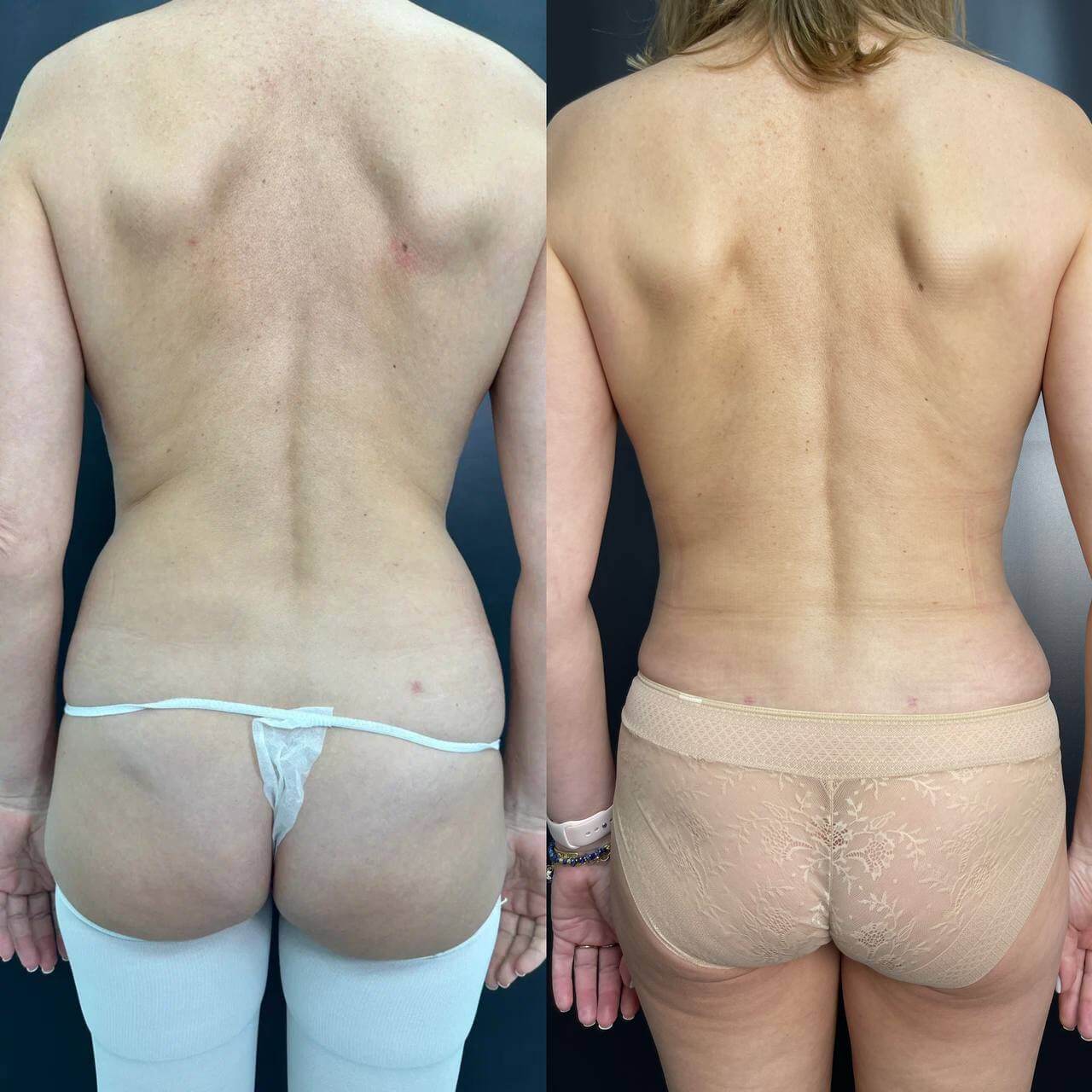 Ушивание диастаза 01