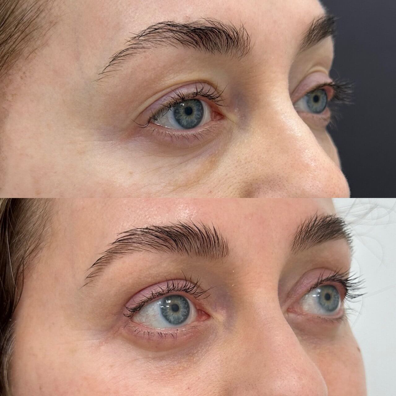 Нижняя блефаропластика 01