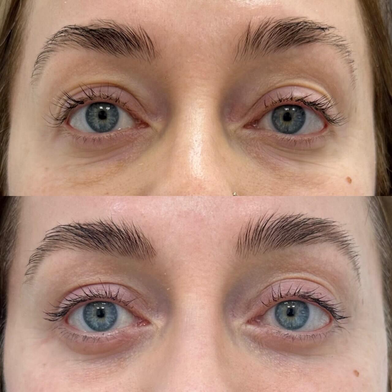 Нижняя блефаропластика 01