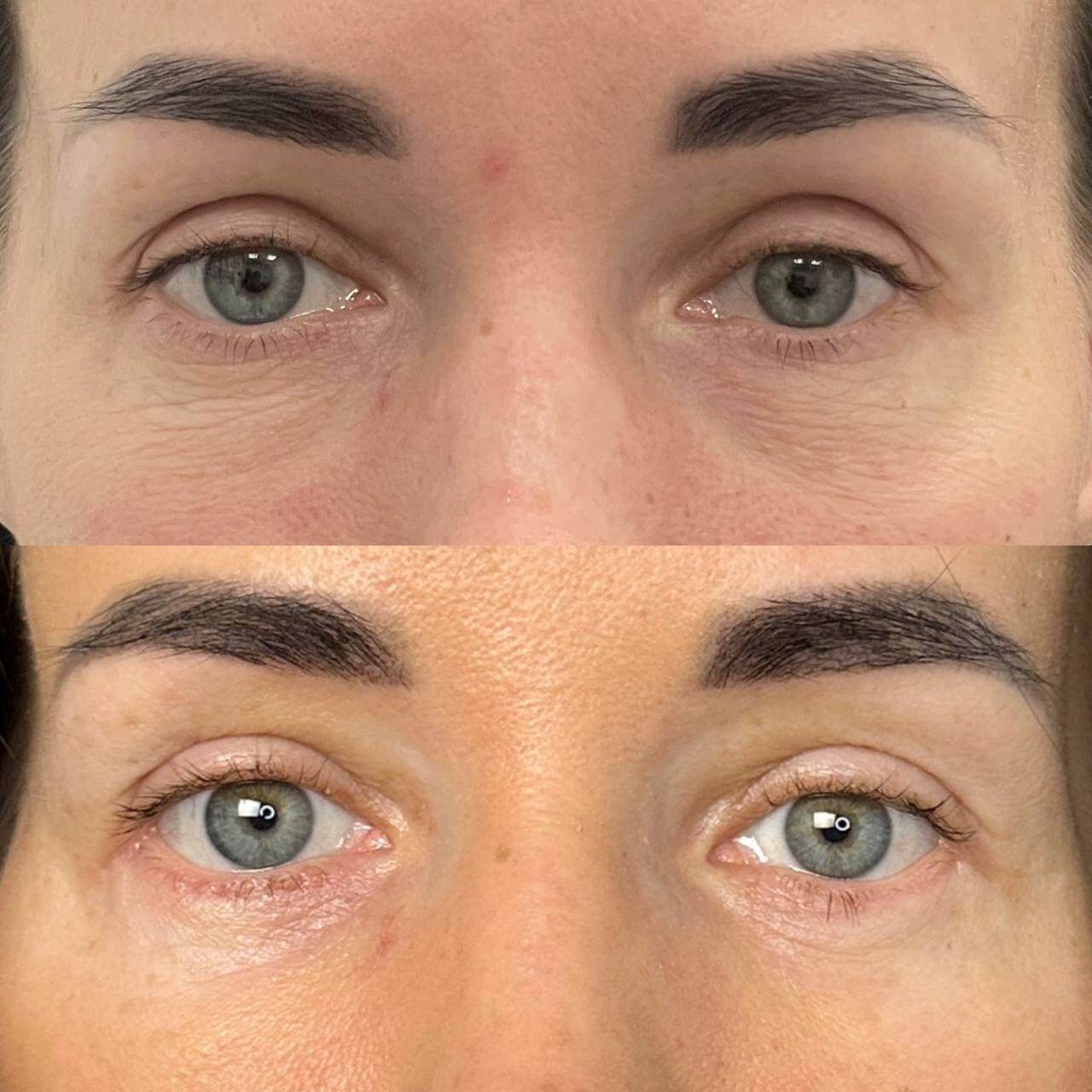 Нижняя блефаропластика 01