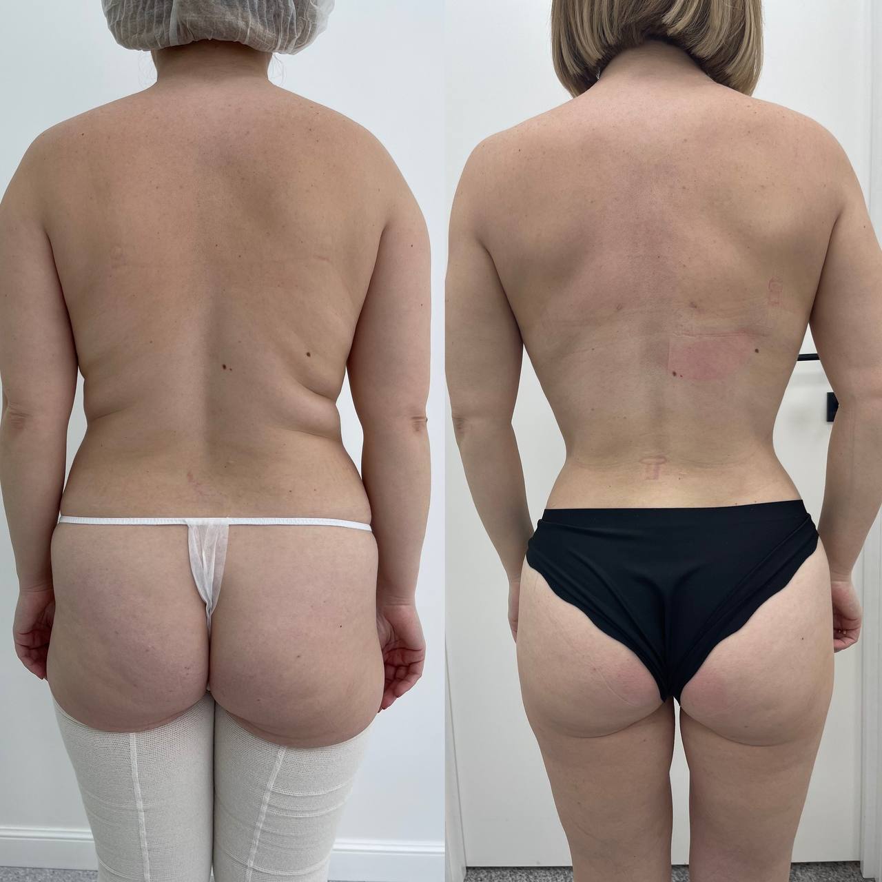 Липофилинг ягодиц 01