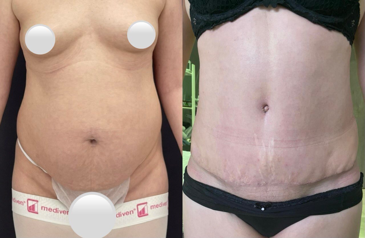 Абдоминопластика с переносом пупка 01