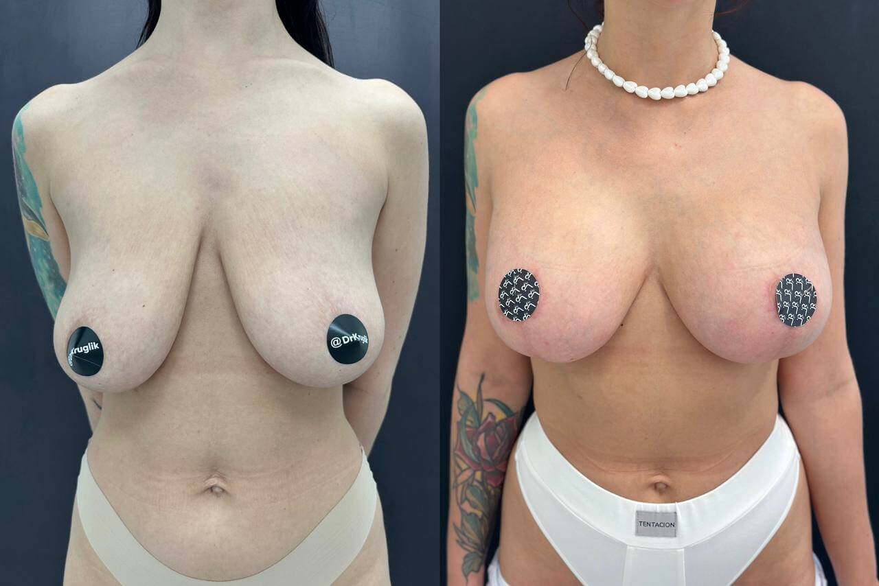 Уменьшение груди (редукция) 01