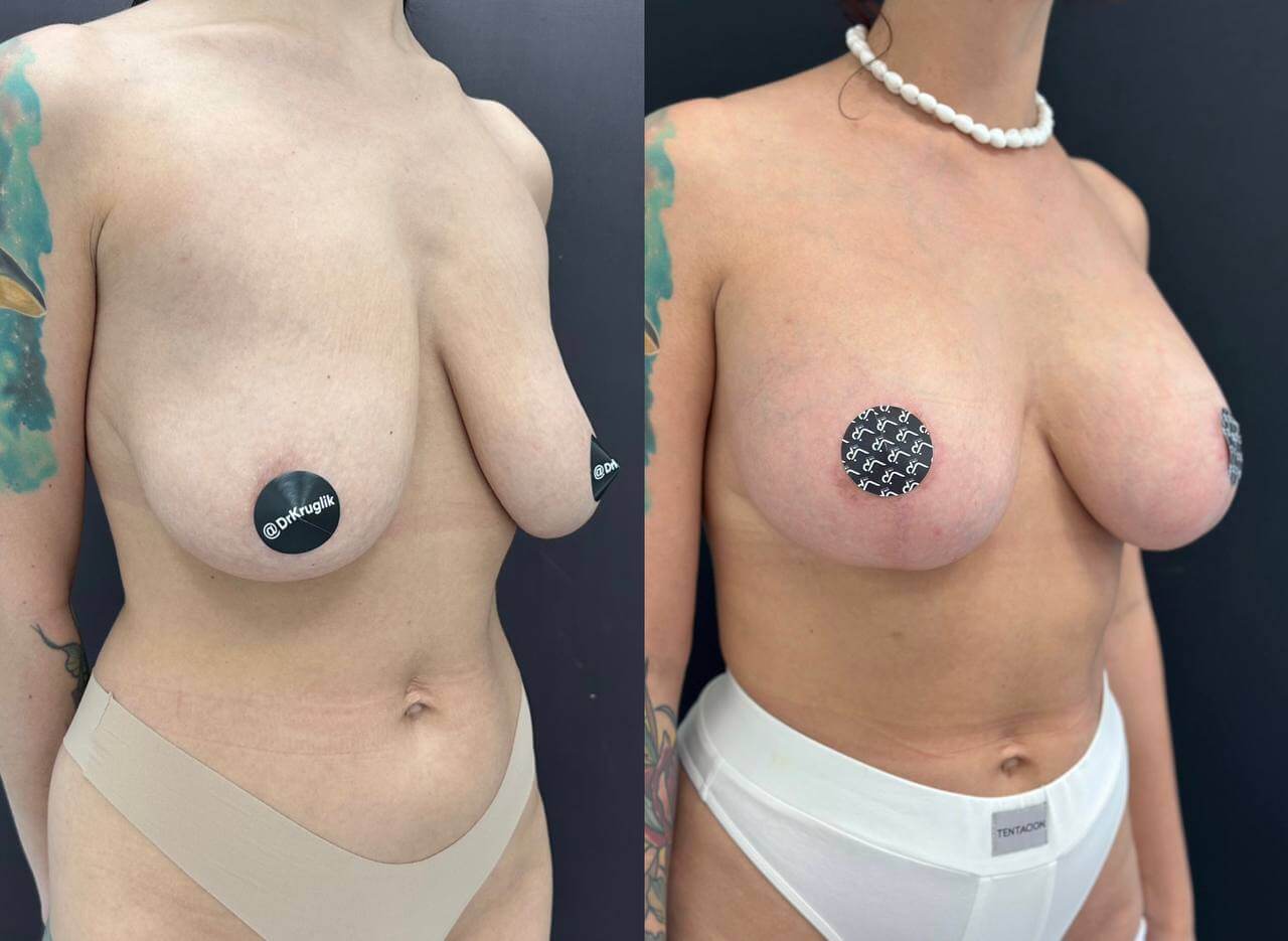Уменьшение груди (редукция) 01
