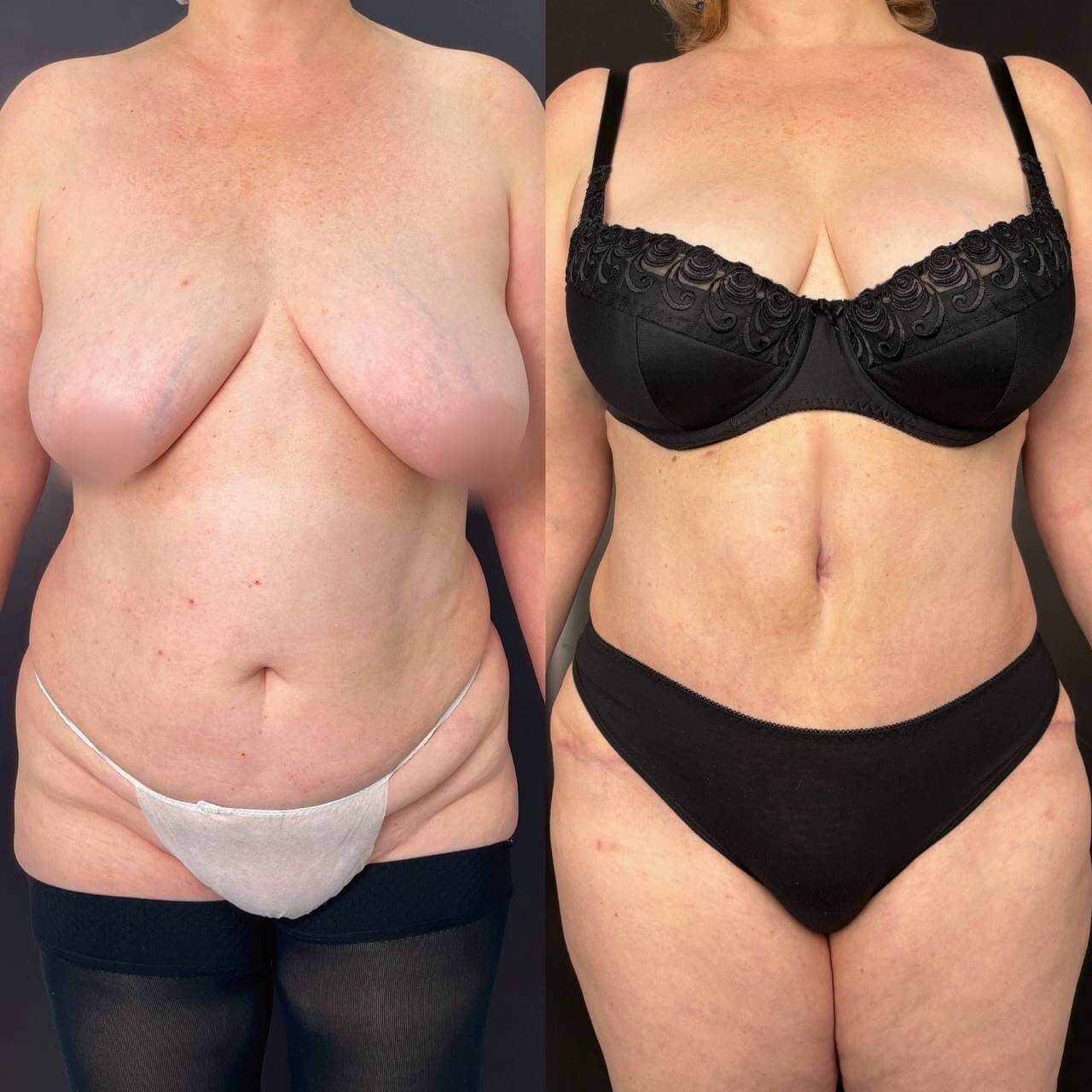 Ушивание диастаза 01