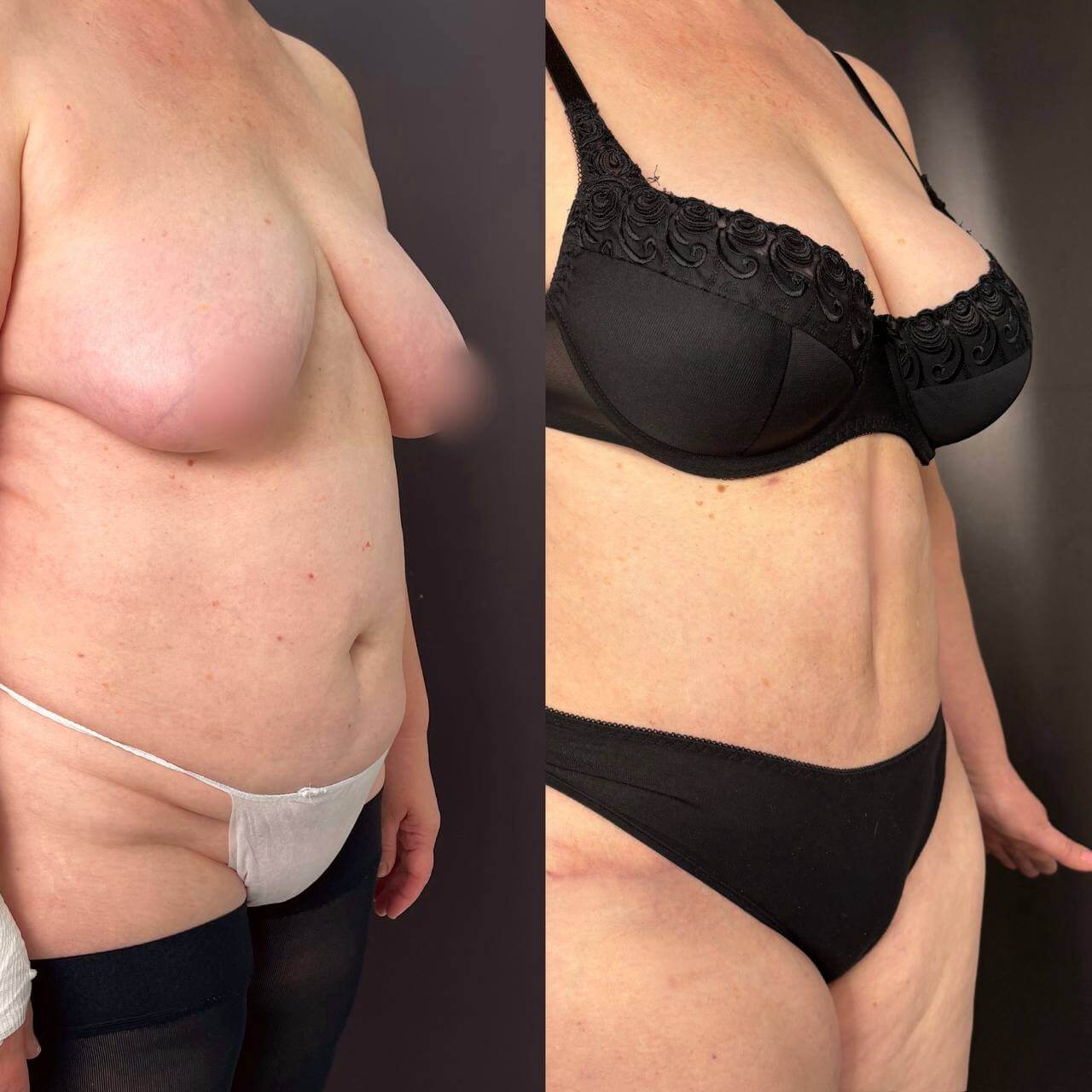 Ушивание диастаза 01