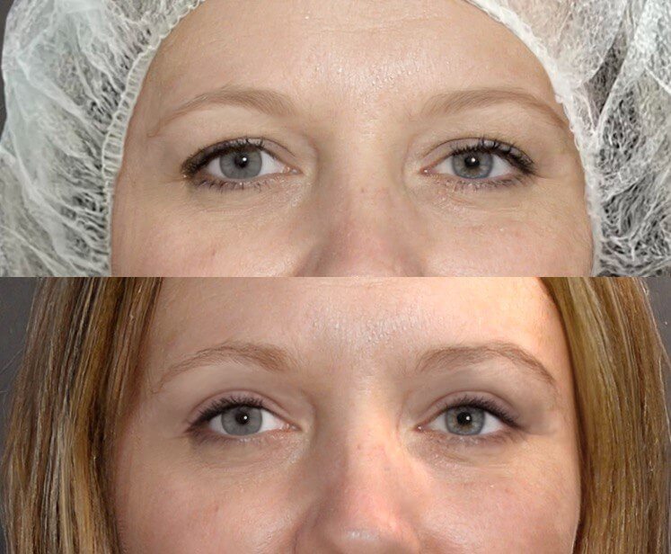 Нижняя блефаропластика 01