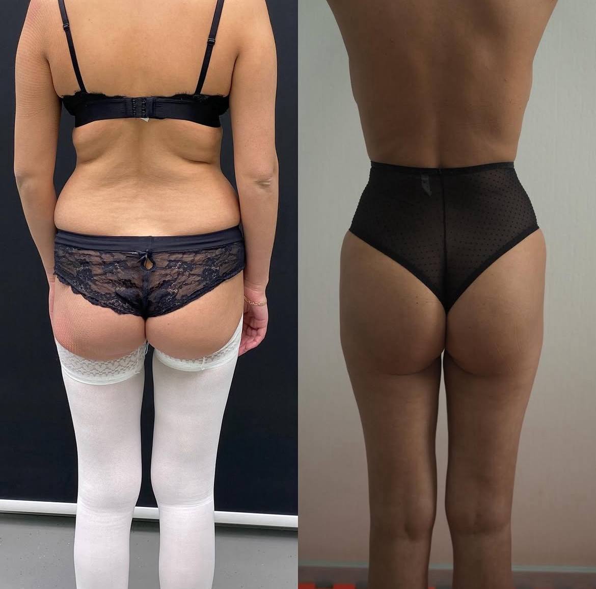 Липофилинг ягодиц 01