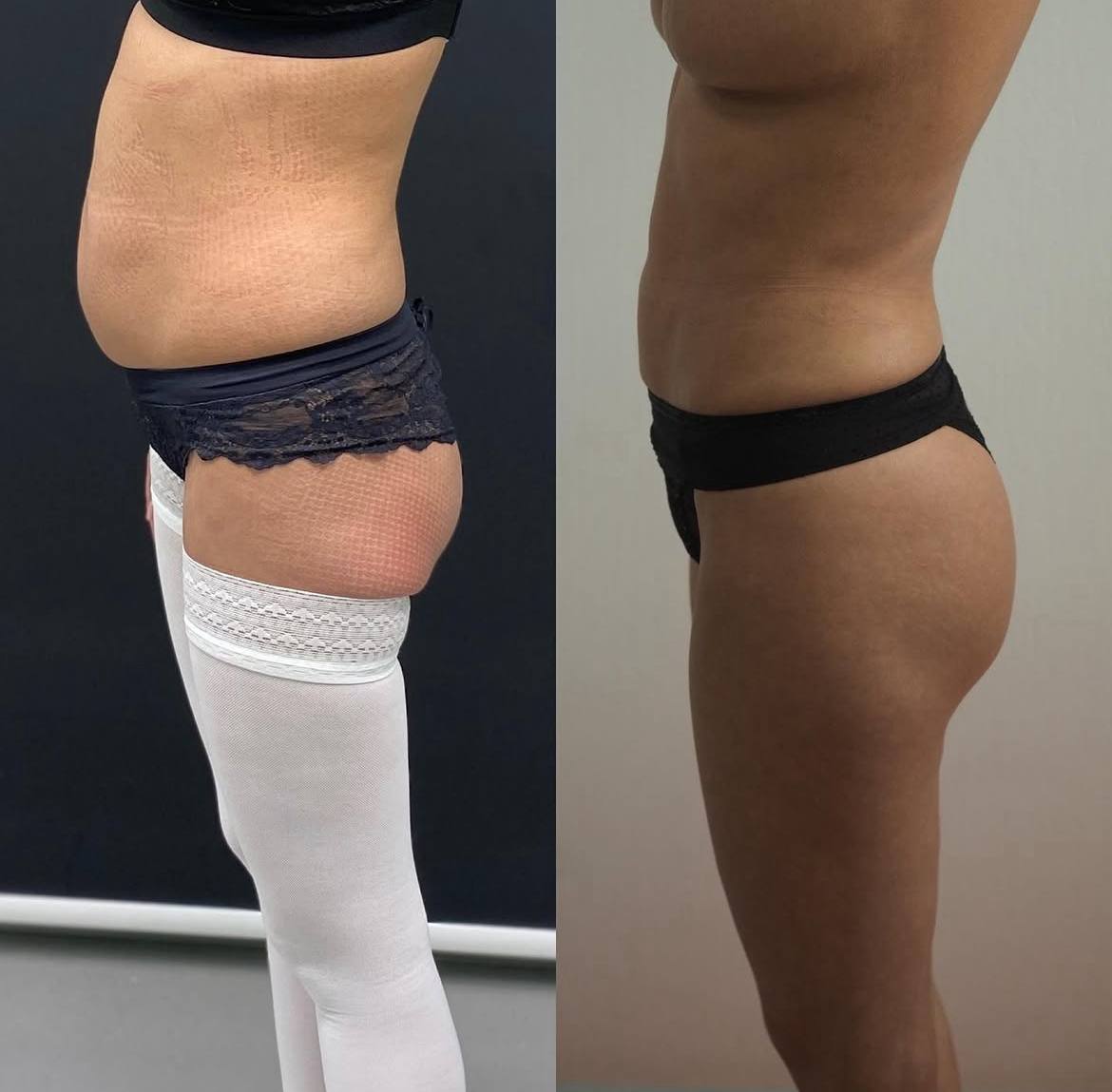 Липофилинг ягодиц 01