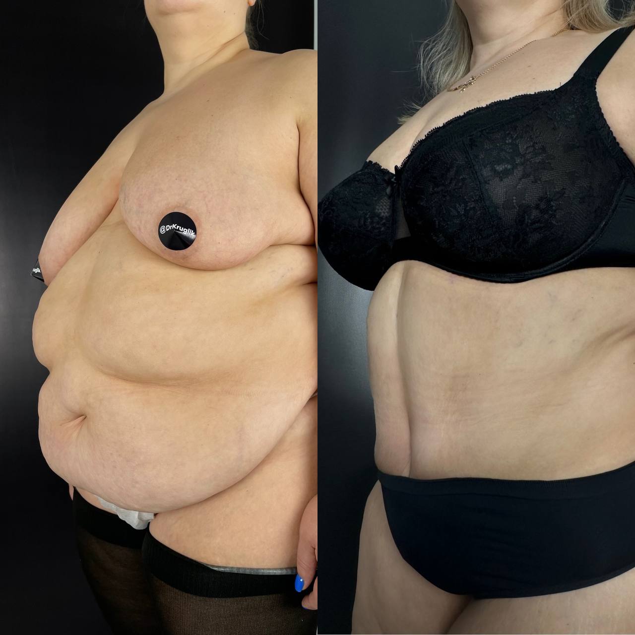 Абдоминопластика с переносом пупка 01