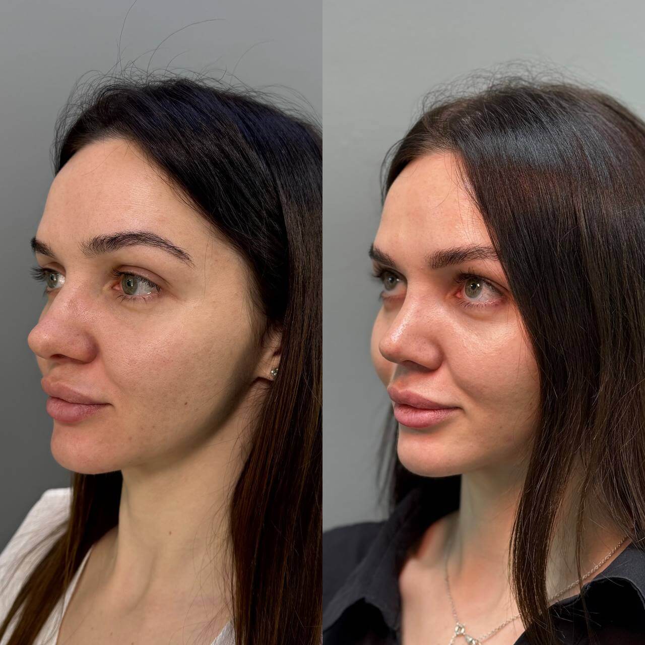 Ринопластика 01