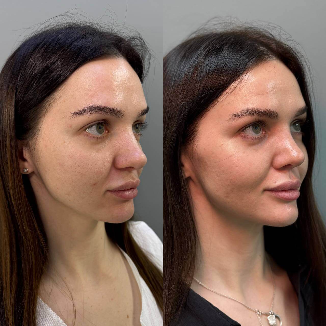 Ринопластика 01