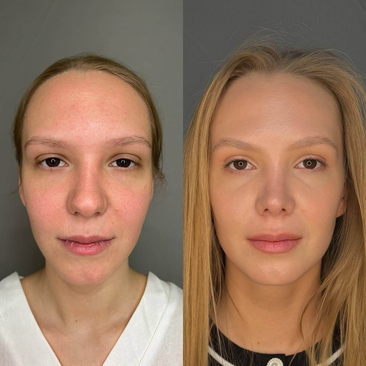 Ринопластика 01