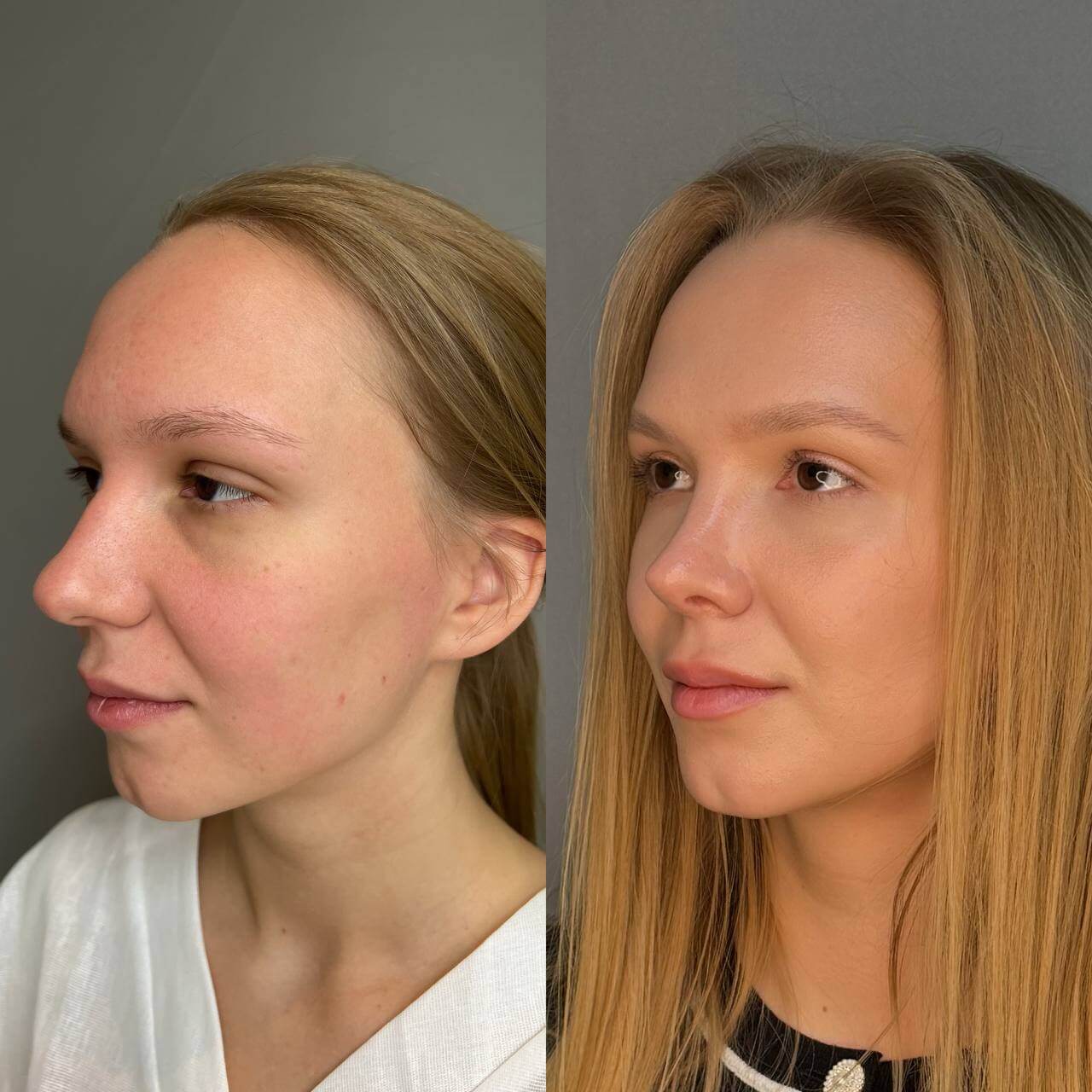 Ринопластика 01