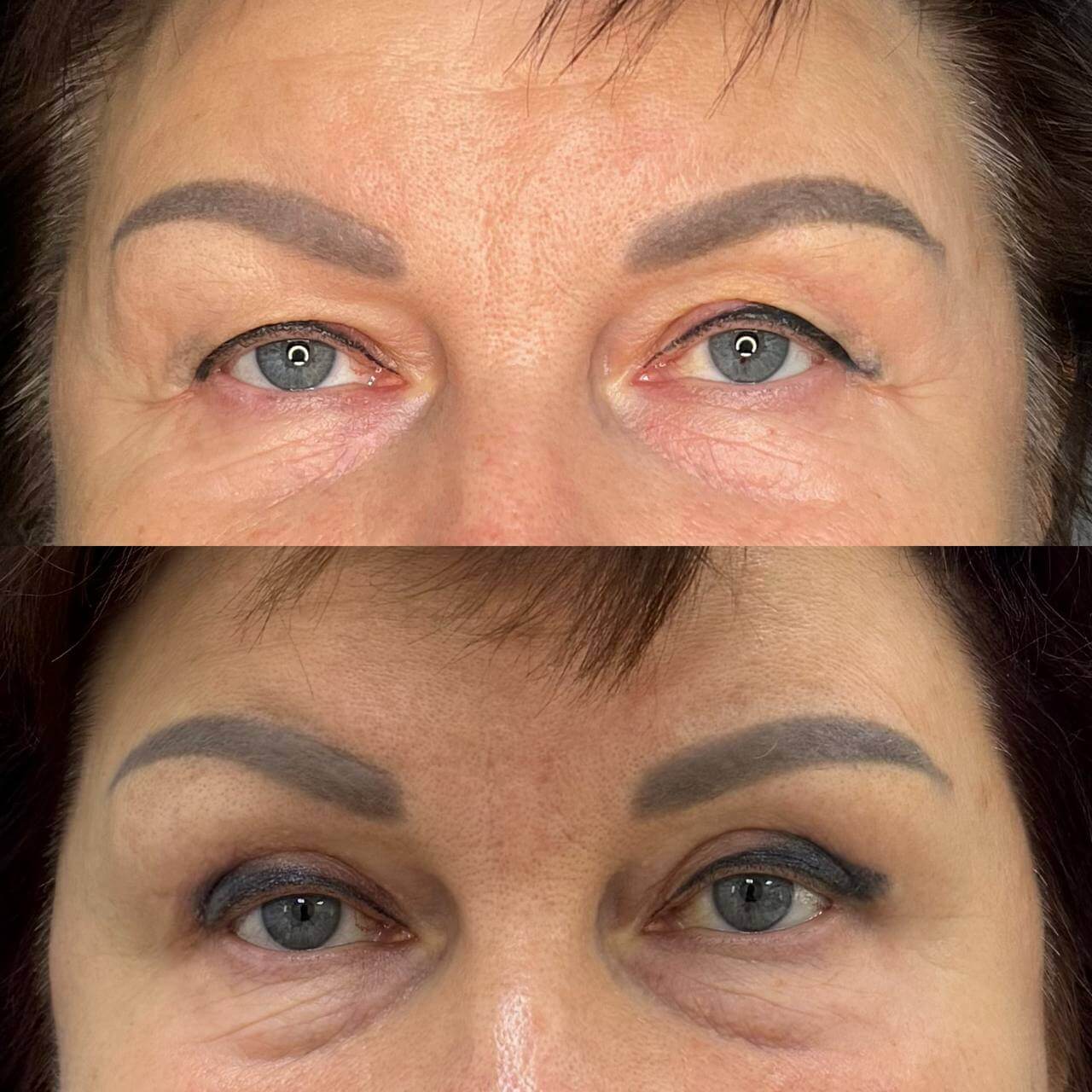 Нижняя блефаропластика 01