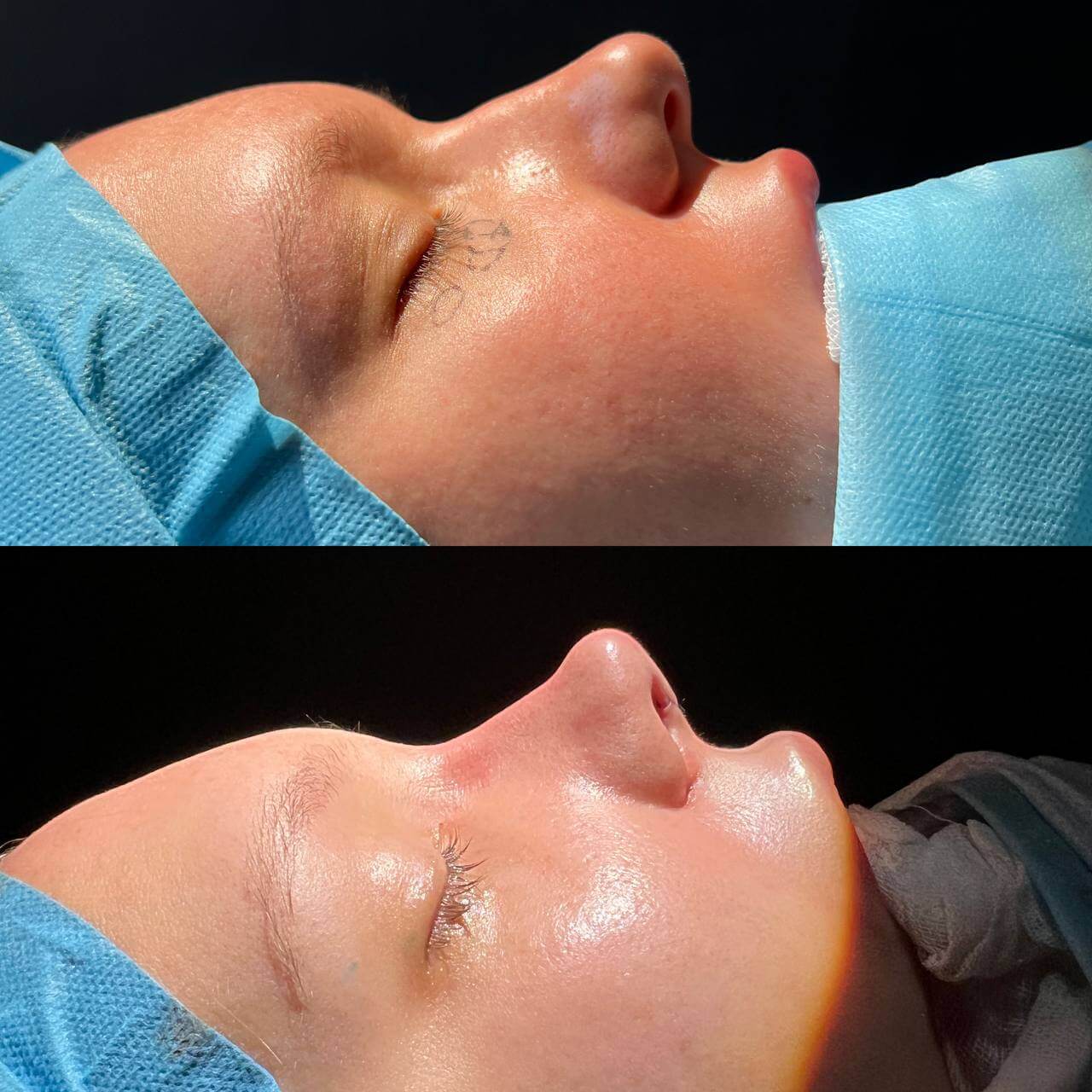 Ринопластика 01