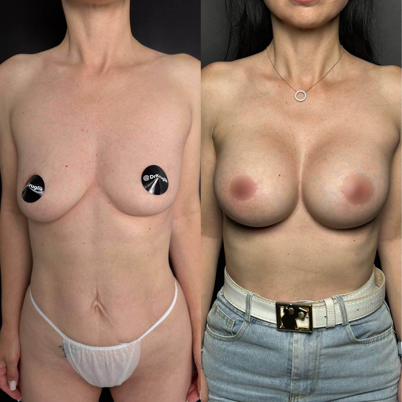 Увеличение груди имплантами 01