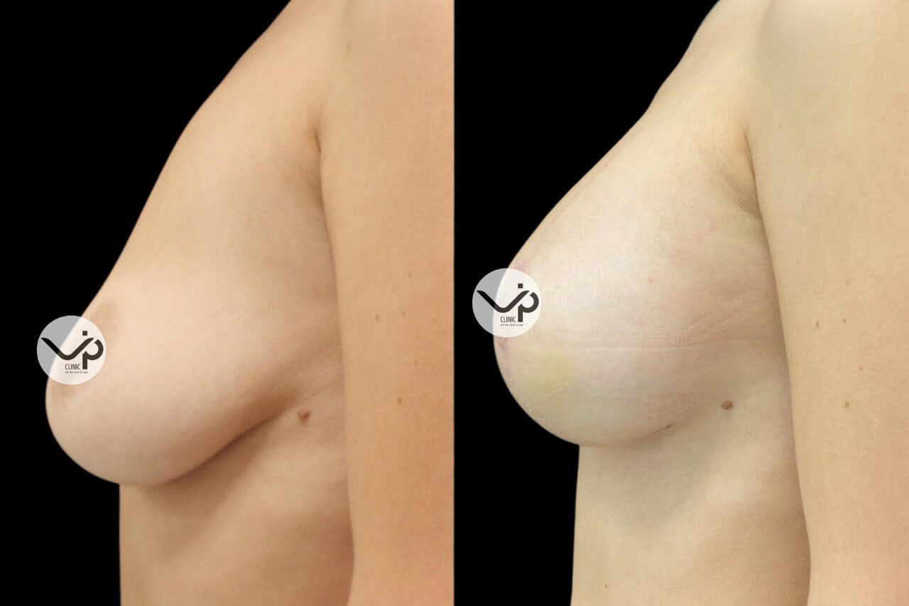 Подтяжка груди (мастопексия) 01