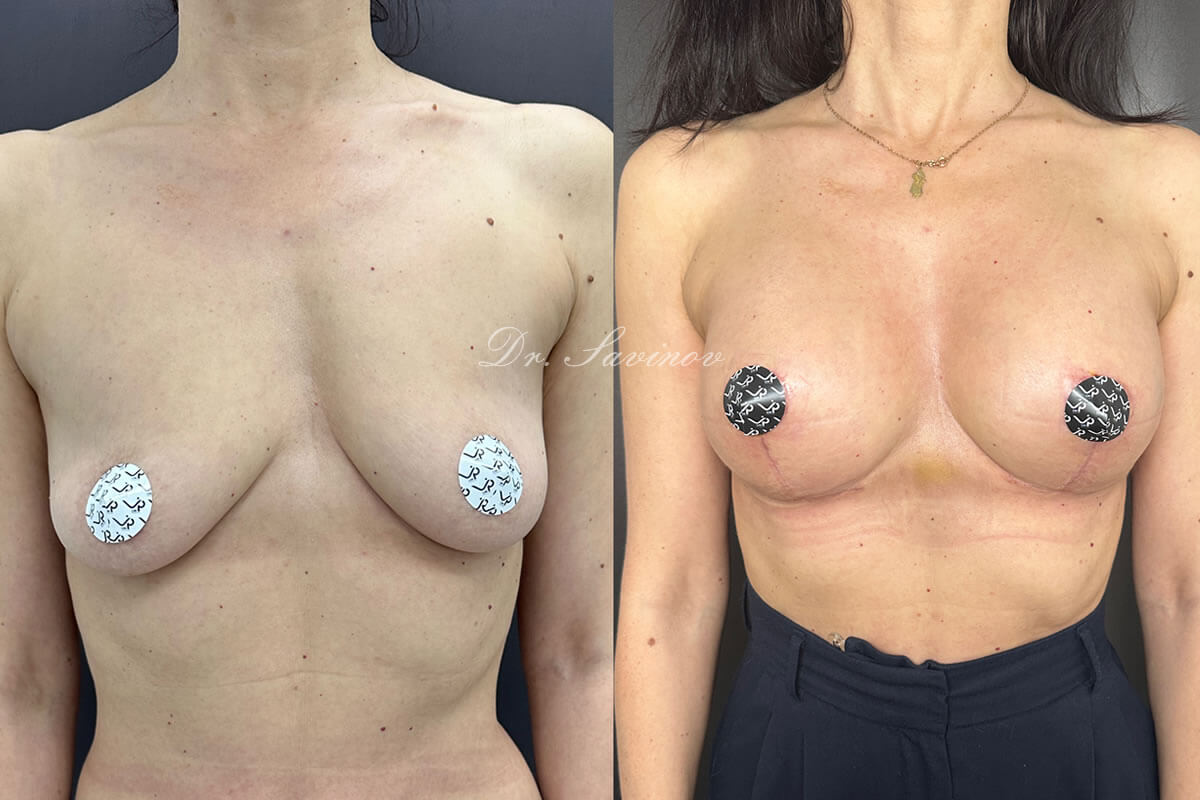 Подтяжка груди (мастопексия) 01