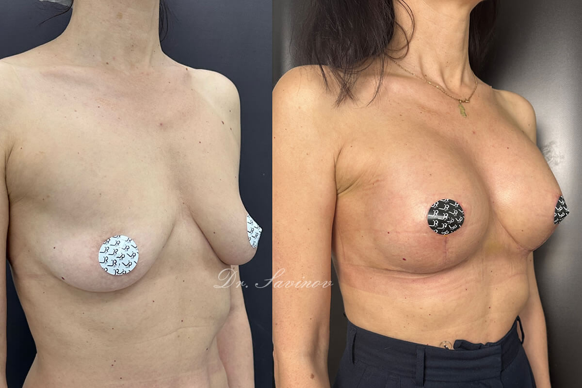 Подтяжка груди (мастопексия) 01