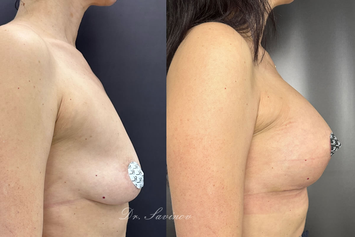 Подтяжка груди (мастопексия) 01