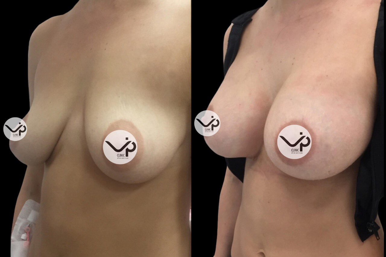 Подтяжка груди (мастопексия) 01