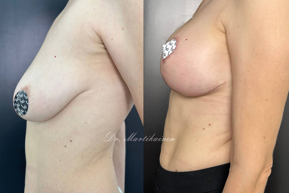 Увеличение груди имплантами 01
