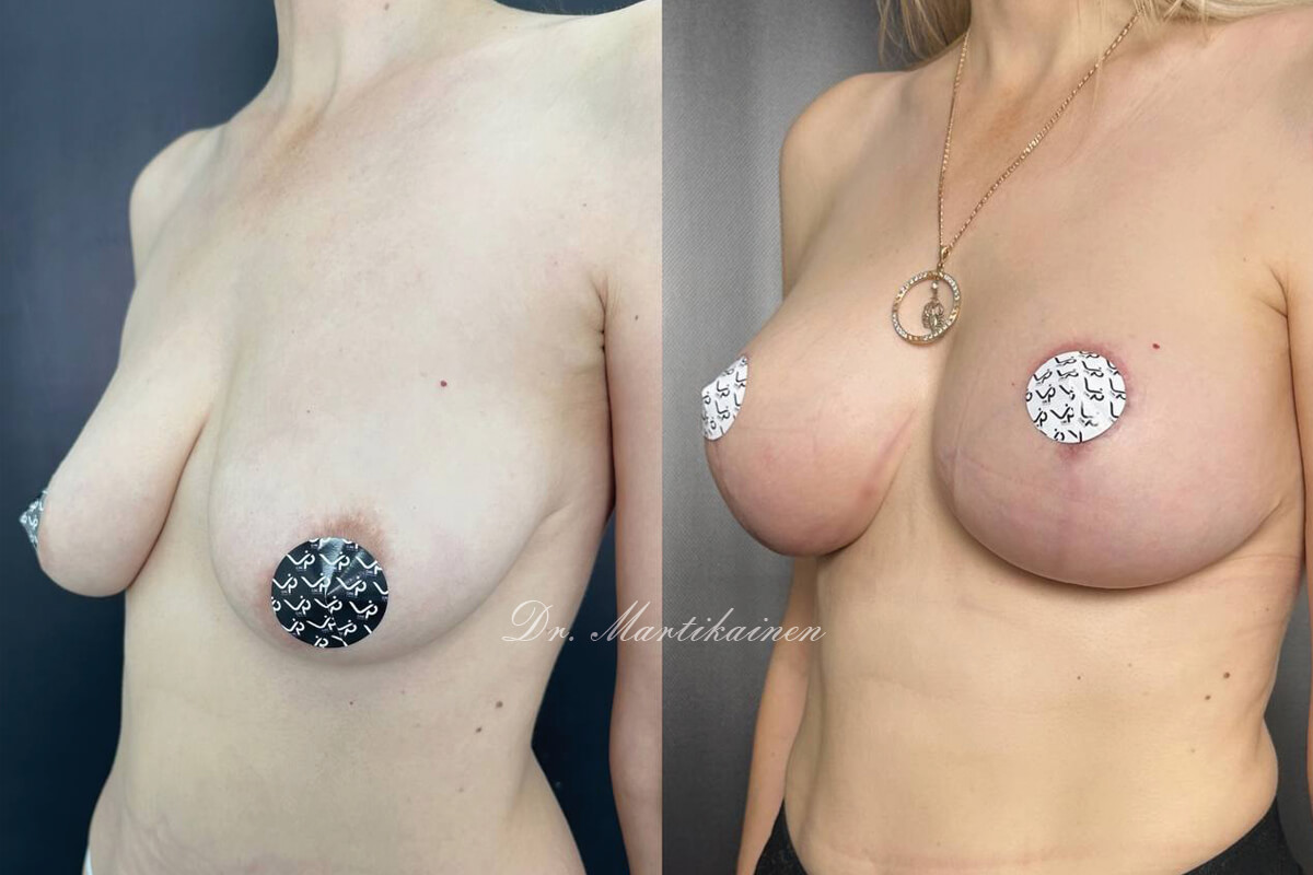 Увеличение груди имплантами 01